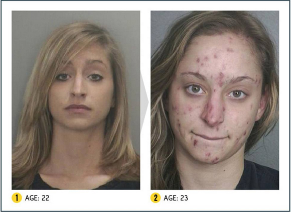 Così la droga stravolge il viso. Campagna choc negli Usa. LE FOTO Così la droga stravolge il viso. Campagna choc negli Usa. LE FOTO