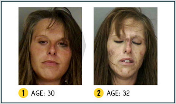 Così la droga stravolge il viso. Campagna choc negli Usa. LE FOTO Così la droga stravolge il viso. Campagna choc negli Usa. LE FOTO