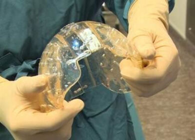 Impiantato su una donna il primo cranio stampato in 3D