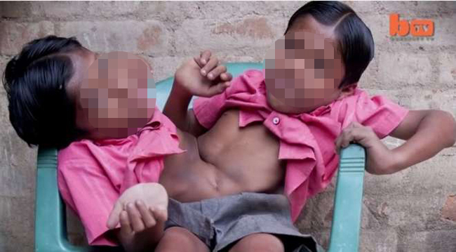 Gemelli siamesi uniti dalle gambe. L’India li considera divinità. FOTO Gemelli siamesi uniti dalle gambe. L’India li considera divinità. FOTO