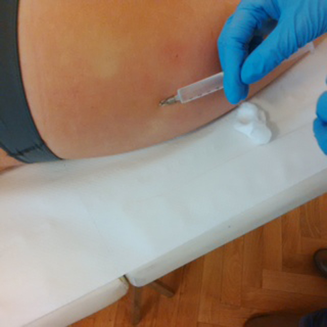 Cellulite, ecco come eliminarla con il mesotaping
