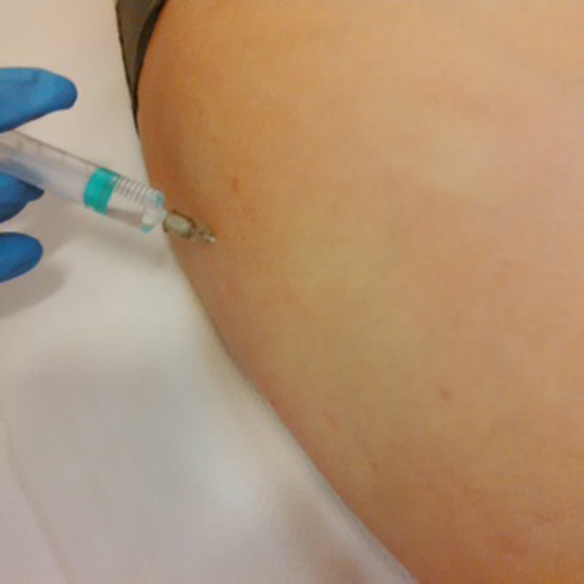 Cellulite, ecco come eliminarla con il mesotaping