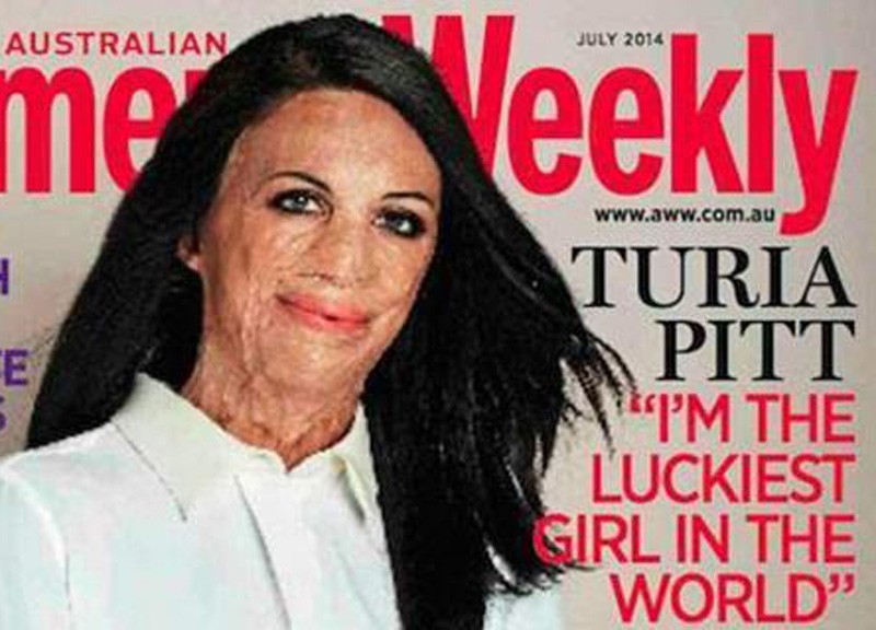 Turia Pitt, sfigurata dalle ustioni. “Ma sono la donna più fortunata” Turia Pitt, sfigurata dalle ustioni. “Ma sono la donna più fortunata”