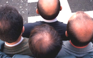 PRP capelli, la cura della calvizie tramite la Rigenerazione Cellulare bSBS evolve la terapia “PRP HT”