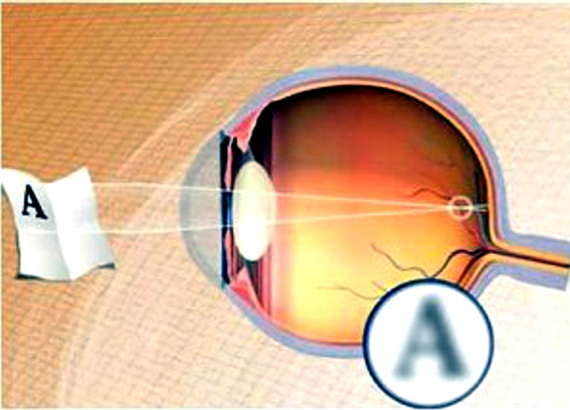 Medicina, laserterapia per curare i difetti di refrazione Medicina, laserterapia per curare i difetti di refrazione