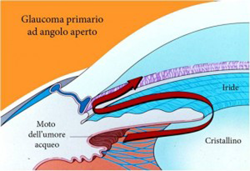 glaucoma (2) glaucoma (2)