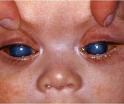 glaucoma (3) glaucoma (3)