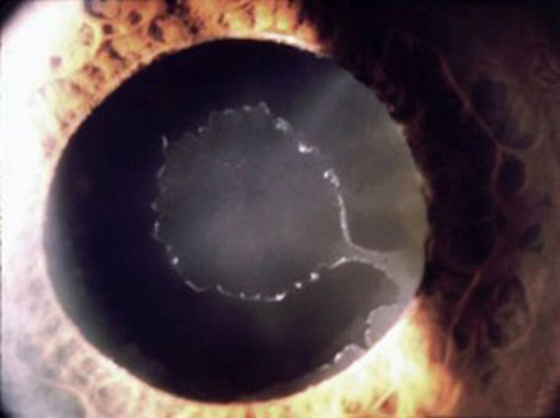glaucoma (6) glaucoma (6)
