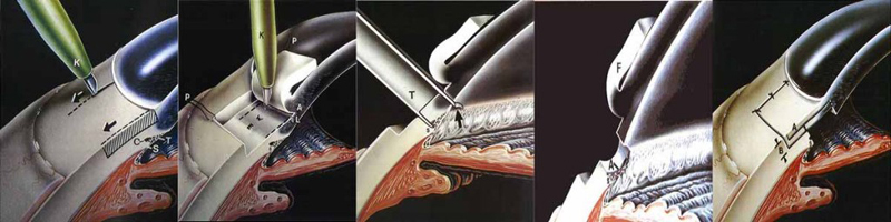 glaucoma glaucoma