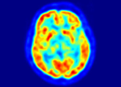 Cancro al cervello, ricercatore italiano realizza un farmaco