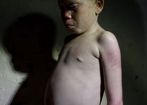 Bimbo albino di un anno barbaramente mutilato in Tanzania Bimbo albino di un anno barbaramente mutilato in Tanzania