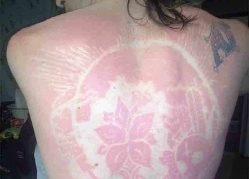 Abbronzatura, l’ultima tendenza? La “sunburn art”. Ma è allarme Abbronzatura, l’ultima tendenza? La “sunburn art”. Ma è allarme