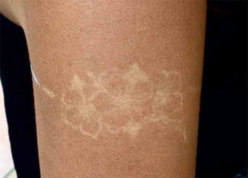 Abbronzatura, l’ultima tendenza? La “sunburn art”. Ma è allarme Abbronzatura, l’ultima tendenza? La “sunburn art”. Ma è allarme