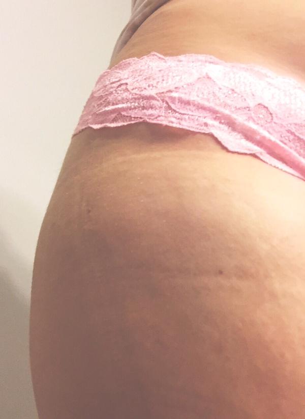 #ThighReading, smagliature e cellulite diventano social #ThighReading, smagliature e cellulite diventano social
