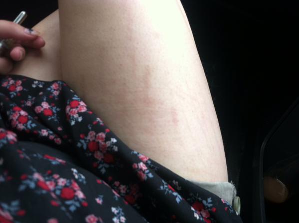 #ThighReading, smagliature e cellulite diventano social #ThighReading, smagliature e cellulite diventano social