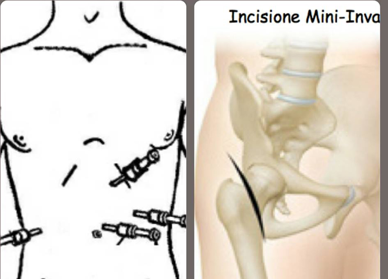 Chirurgia mininvasiva, una moda salutare? Chirurgia mininvasiva, una moda salutare?