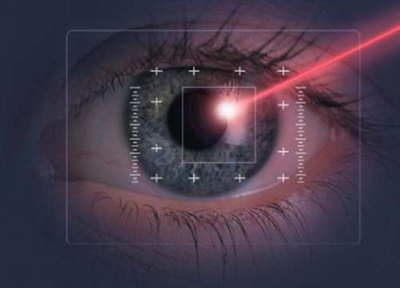 Trapianto di cornea. Nuova rivoluzione laser Trapianto di cornea. Nuova rivoluzione laser