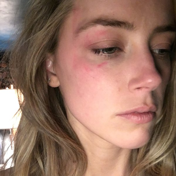 Amber Heard mostra i lividi: “E’ stato Johnny Deep”