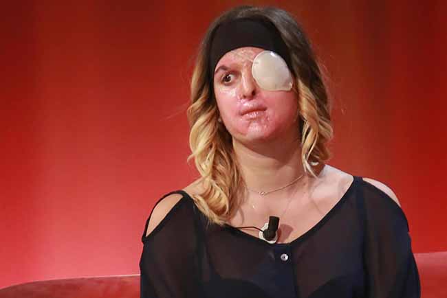 Gessica Notaro, la miss sfregiata con l’acido, mostra il suo volto in tv. Foto