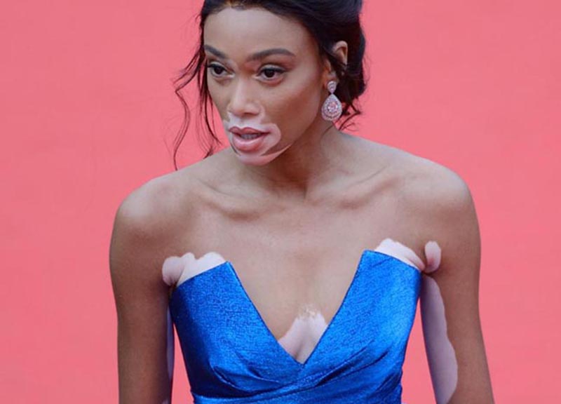 Winnie Harlow, la modella con la vitiligine. Cannes, speciale red carpet Winnie Harlow, la modella con la vitiligine. Cannes, speciale red carpet