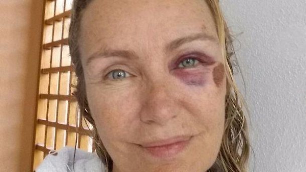 Licia Colò, occhio nero e botta in testa. “Amici miei sono ancora con voi” Licia Colò, occhio nero e botta in testa. “Amici miei sono ancora con voi”