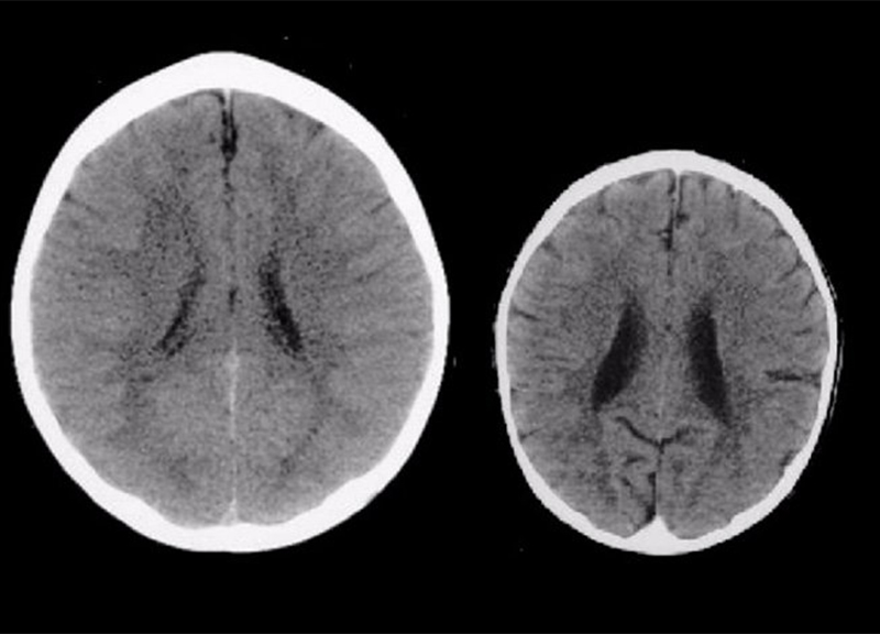 Abusi sui minori come capirlo: Tac al cervello rivela la presenza di traumi Abusi sui minori come capirlo: Tac al cervello rivela la presenza di traumi
