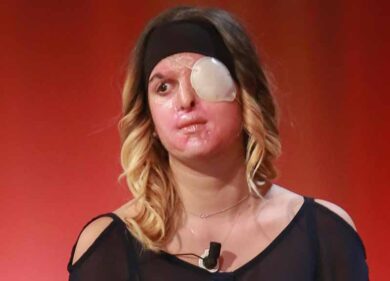 Altaroma, la miss sfigurata con l’acido dal fidanzato sfila per Gattinoni