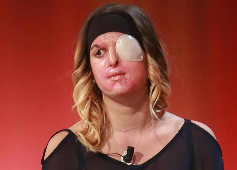 Altaroma, la miss sfigurata con l’acido dal fidanzato sfila per Gattinoni Altaroma, la miss sfigurata con l’acido dal fidanzato sfila per Gattinoni