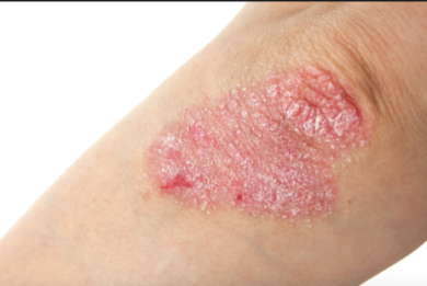 Psoriasi: Novartis annuncia nuovi dati su secukinumab e qualità della vita