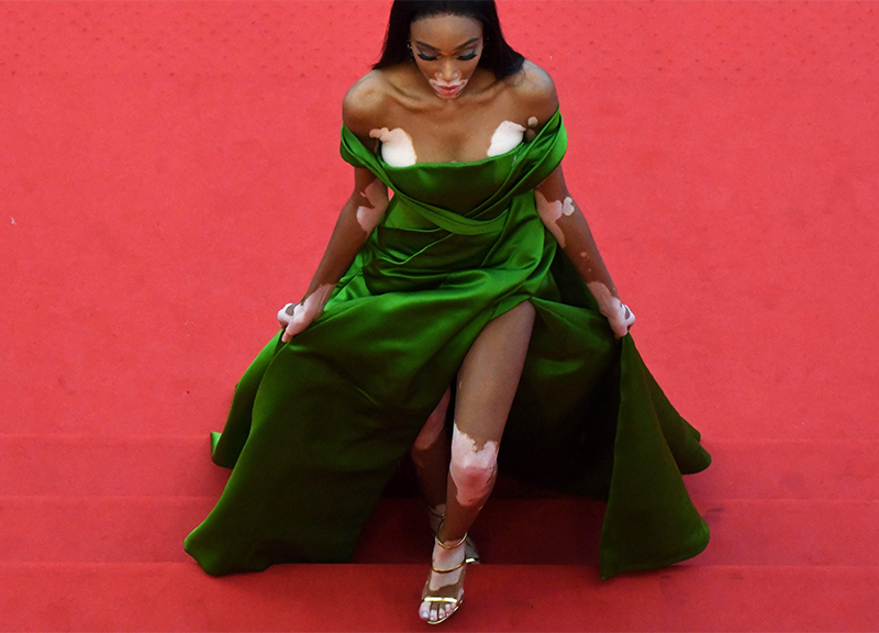 Winnie Harlow, la top con la vitiligine, conquista le passerelle. FOTO