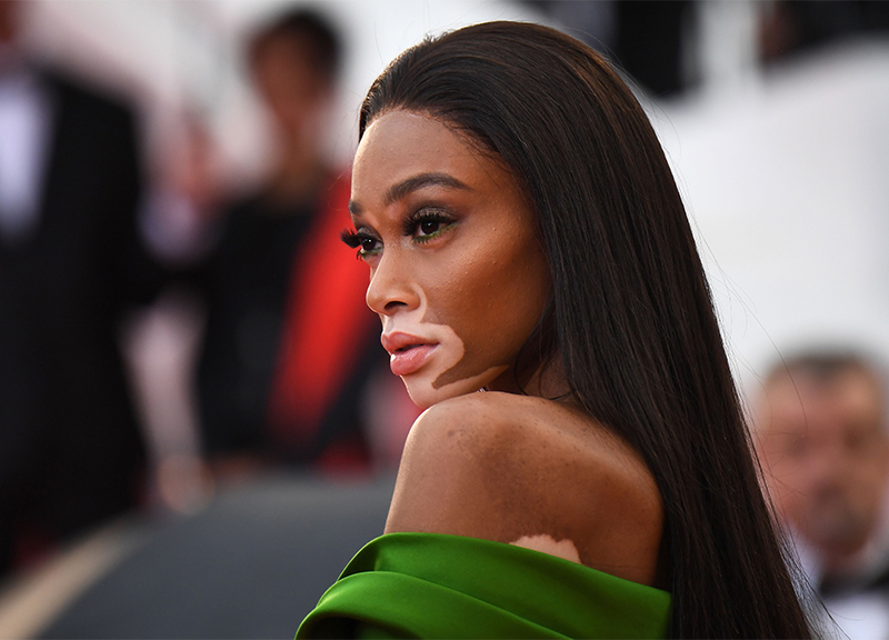 Winnie Harlow, la top con la vitiligine, conquista le passerelle. FOTO