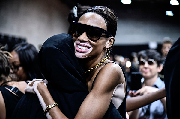 Winnie Harlow, la top con la vitiligine, conquista le passerelle. FOTO