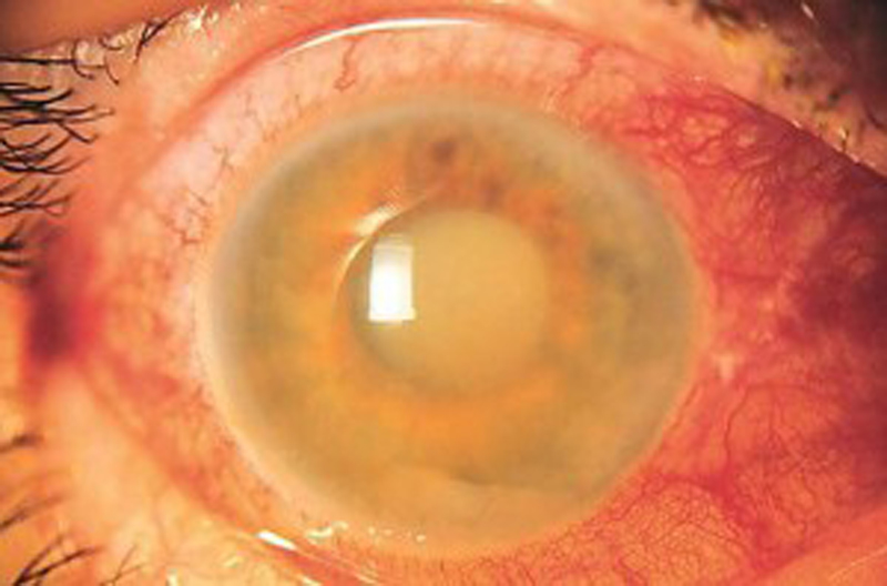 Glaucoma, nuova cura: un collirio creato col cordone ombelicale Glaucoma, nuova cura: un collirio creato col cordone ombelicale