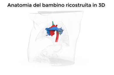 Impiantato primo “bronco” 3d su bimbo di 5 anni al Bambino Gesù. Il record