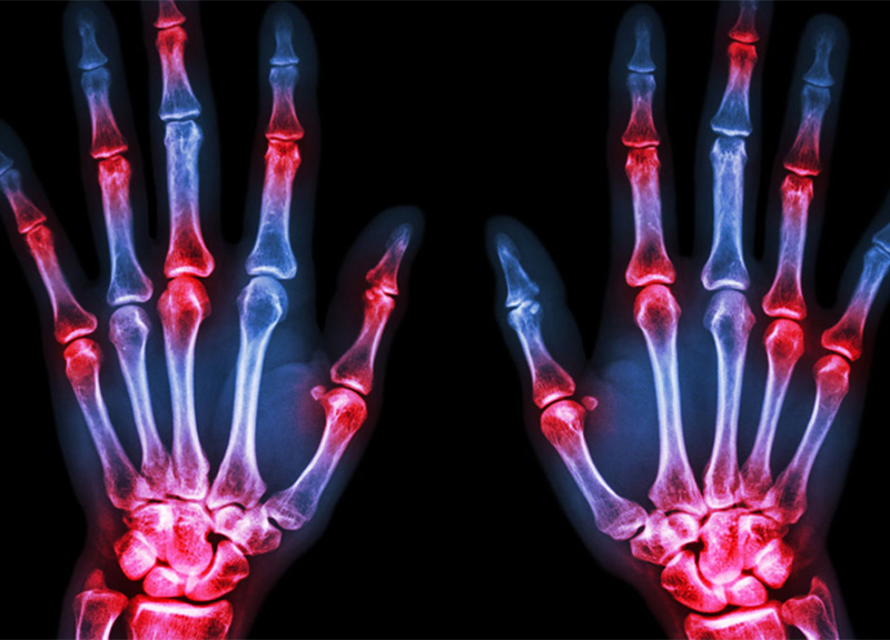 Artrite reumatoide, 7 sintomi iniziali da non sottovalutare Artrite reumatoide, 7 sintomi iniziali da non sottovalutare