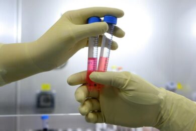 Paralisi cerebrale infantile: negli Usa trattamento sperimentale con cellule staminali del cordone ombelicale