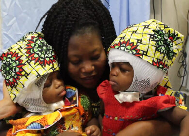 Separate a Roma due gemelle siamesi. Ervina e Prefina commuovono l’Italia