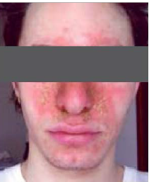 Mascherine per il Covid-19: come evitare che la dermatite seborroica s’aggravi