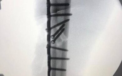 MotoGP, viti e muscoli: ecco il braccio di Marquez dopo l’operazione all’omero