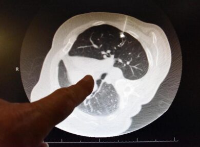 Arrivano i Molecular Tumor Board: ecco come cambia l’approccio ai tumori