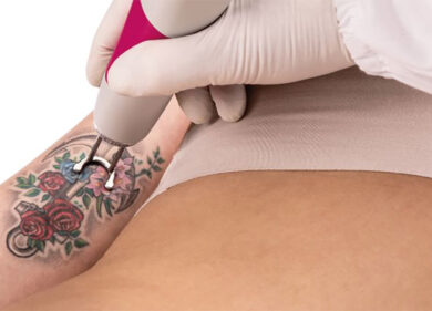 Festeggiare la Festa degli Innamorati rimuovendo il tatuaggio dell’ex partner