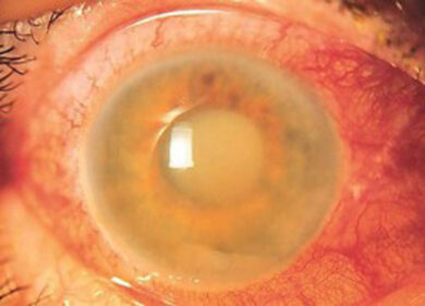 7-13 Marzo settimana  mondiale del glaucoma.