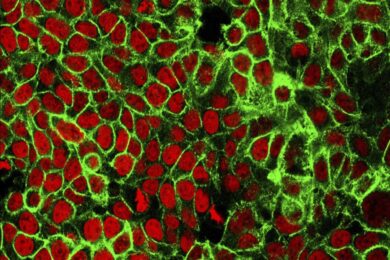Cancro, un milione di casi non diagnosticati in Europa per colpa del Covid