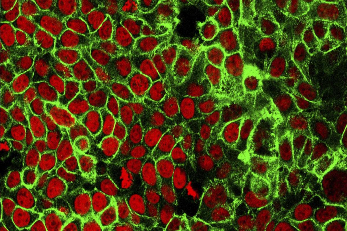 Cancro, un milione di casi non diagnosticati in Europa per colpa del Covid Cancro, un milione di casi non diagnosticati in Europa per colpa del Covid