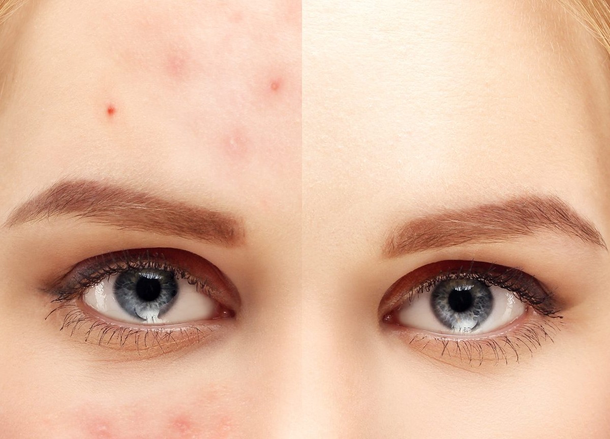 Psoriasi e dermatite atopica: stop a lesioni e prurito con le nuove terapie Psoriasi e dermatite atopica: stop a lesioni e prurito con le nuove terapie