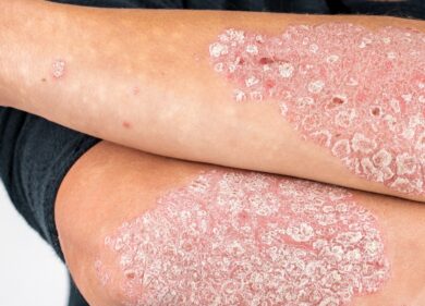 Giornata mondiale della psoriasi: solo in Italia colpite 1,5mln di persone