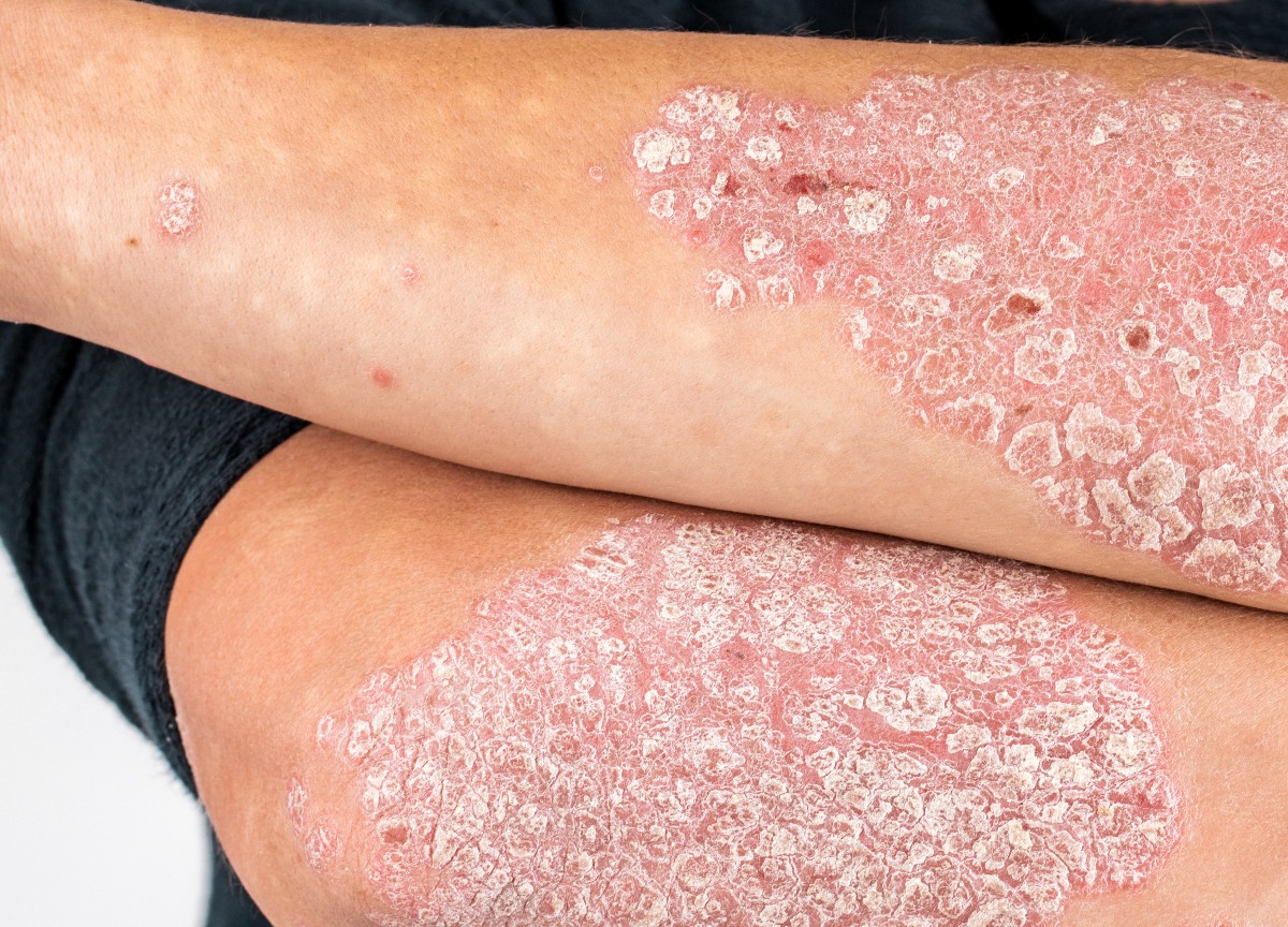 Giornata mondiale della psoriasi: solo in Italia colpite 1,5mln di persone Giornata mondiale della psoriasi: solo in Italia colpite 1,5mln di persone
