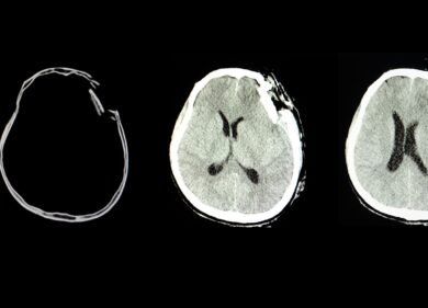 Abbott ottiene marchio CE per primo test di laboratorio per traumi cranici