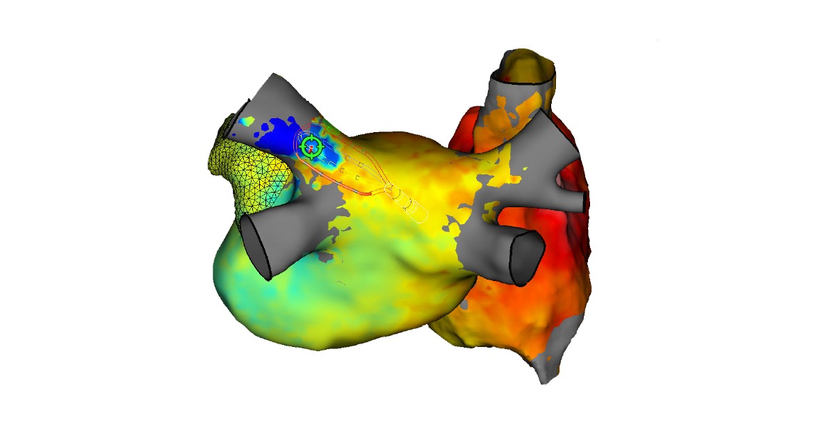 Cuore in 3D: nuova mappatura dell’attività cardiaca per colpire l’aritmia Cuore in 3D: nuova mappatura dell’attività cardiaca per colpire l’aritmia