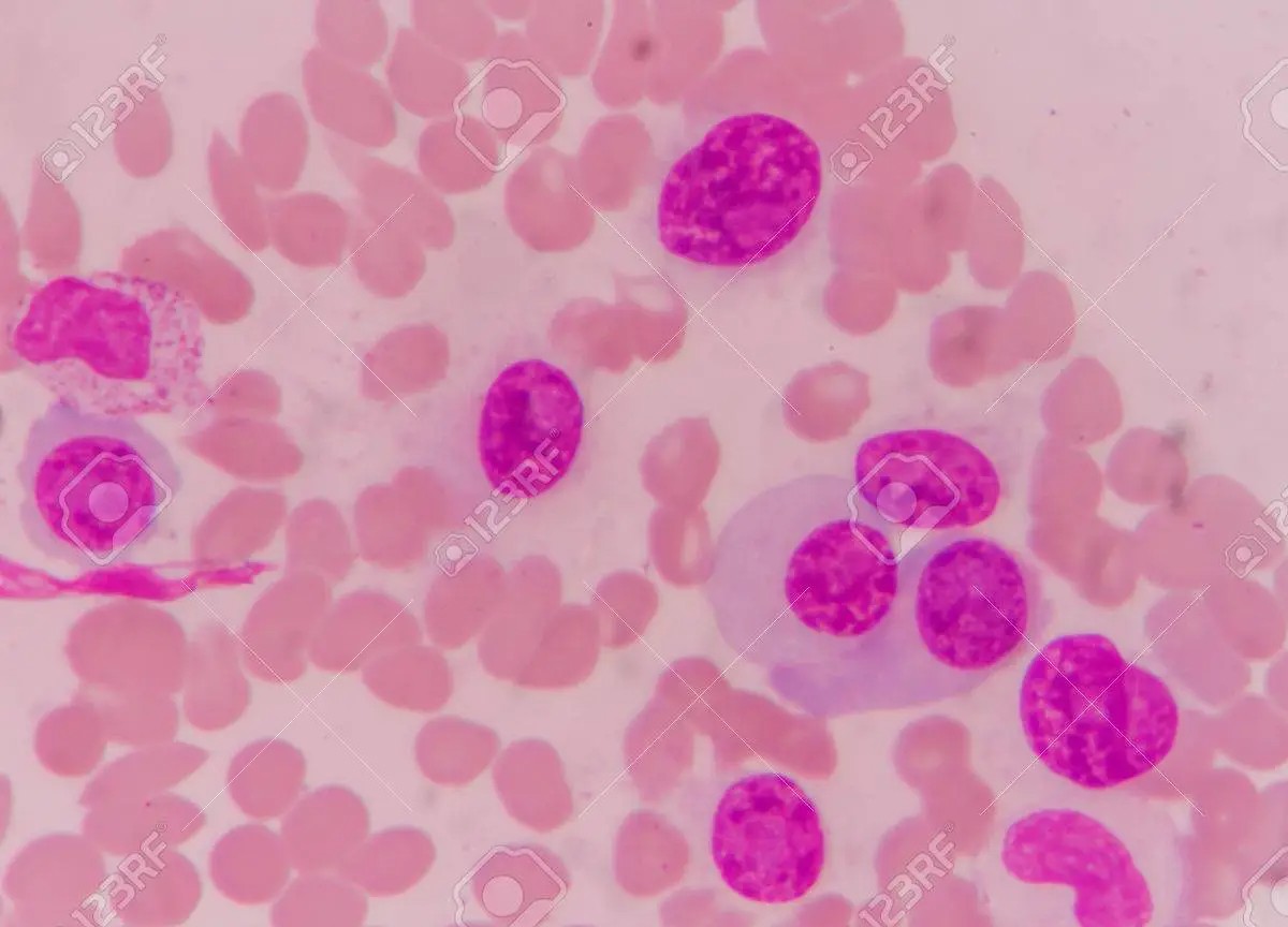 Da Janssen nuovi dati su anticorpi specifici per il trattamento del mieloma Da Janssen nuovi dati su anticorpi specifici per il trattamento del mieloma